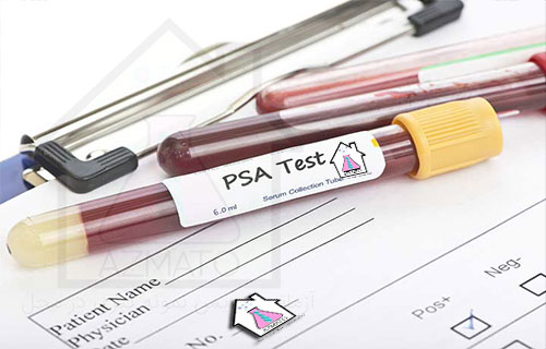 آزمایش PSA سرطان پرستات